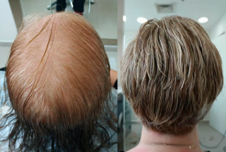 Antes e Depois da Prótese Capilar