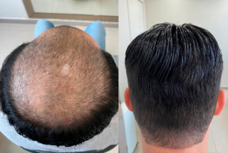 Antes e Depois da Prótese Capilar