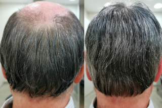 Antes e Depois da Prótese Capilar