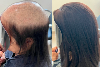 Antes e Depois da Prótese Capilar