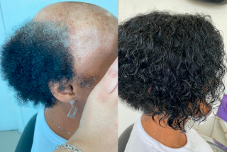 Antes e Depois da Prótese Capilar