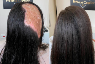 Antes e Depois da Prótese Capilar
