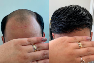 Antes e Depois da Prótese Capilar